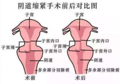 阴道收紧手术一般要几多费用?香港姊妹必睇攻略!
